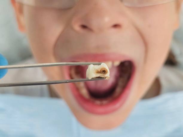 Best Emergency Tooth Extraction in Forestde, AL